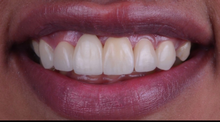 قبل تركيبات-اسنان